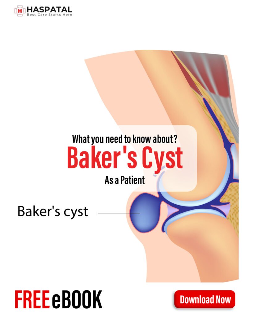 How baker's cyst can affect your health? Haspatal online consultation app