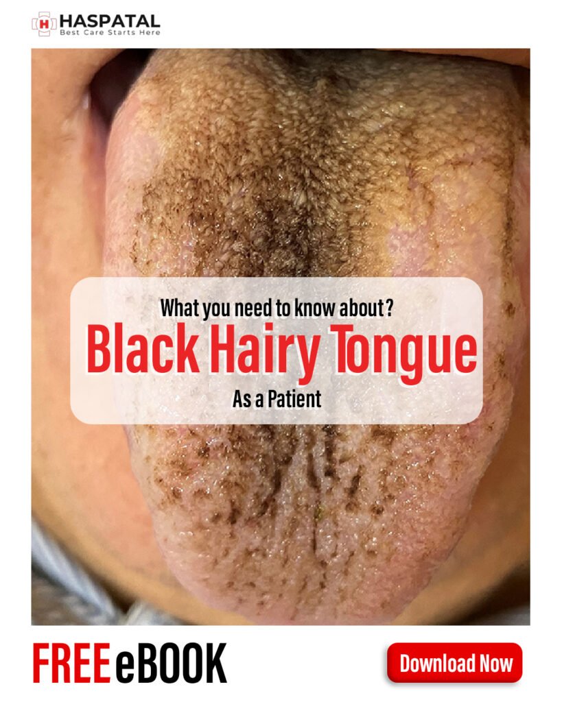Black Hairy Tongue and its Symptoms- Haspatal online consultation app