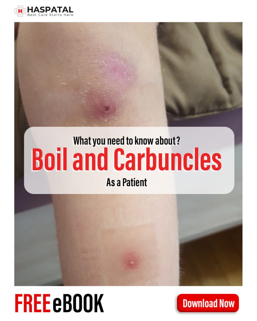 How boils and Carbuncles can affect your body? Haspatal online consultation app