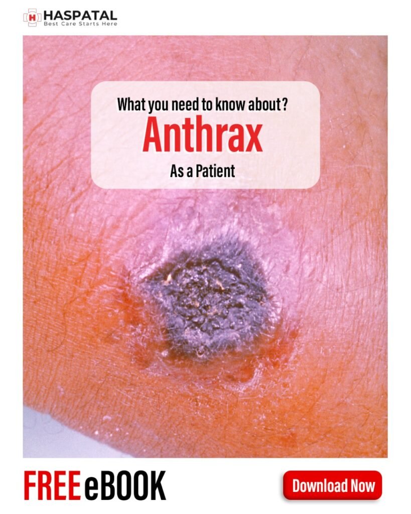 How anthrax can affect your health? Haspatal online consultation app