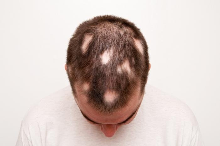 How alopecia areata can affect your hair? Haspatal online consultation app.