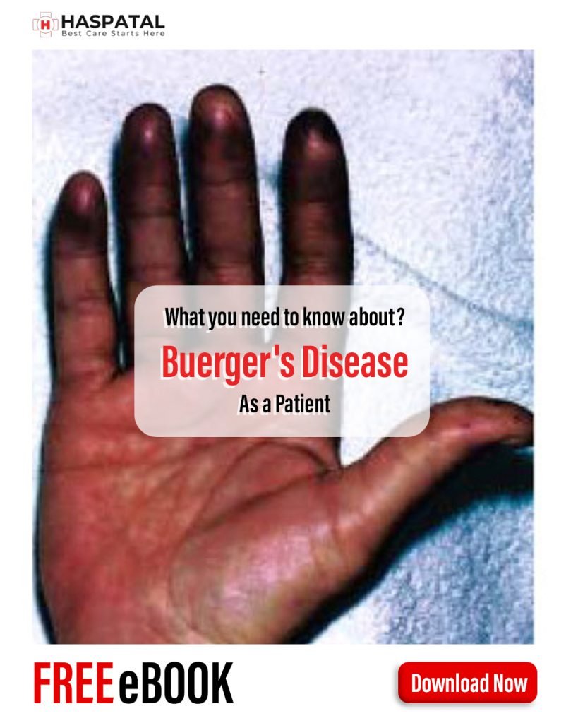 How Buerger's disease can affect your health? Haspatal online doctor consultation app.