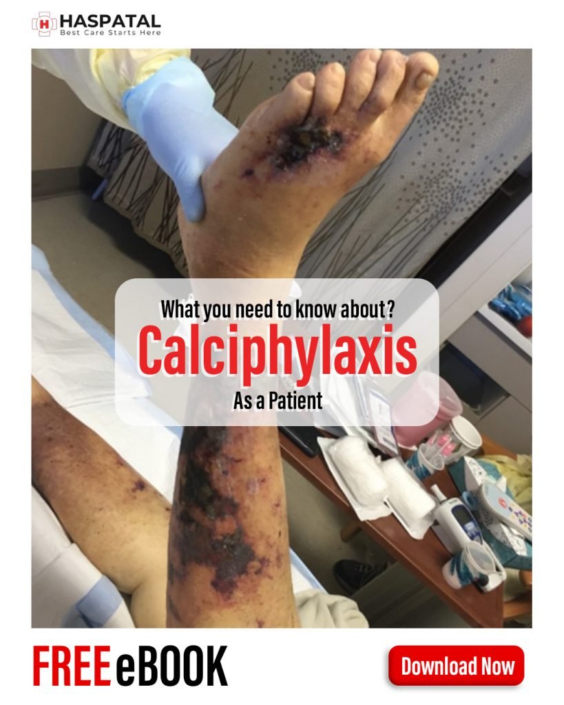 How Calciphylaxis can affect your health? Haspatal online doctor consultation app.