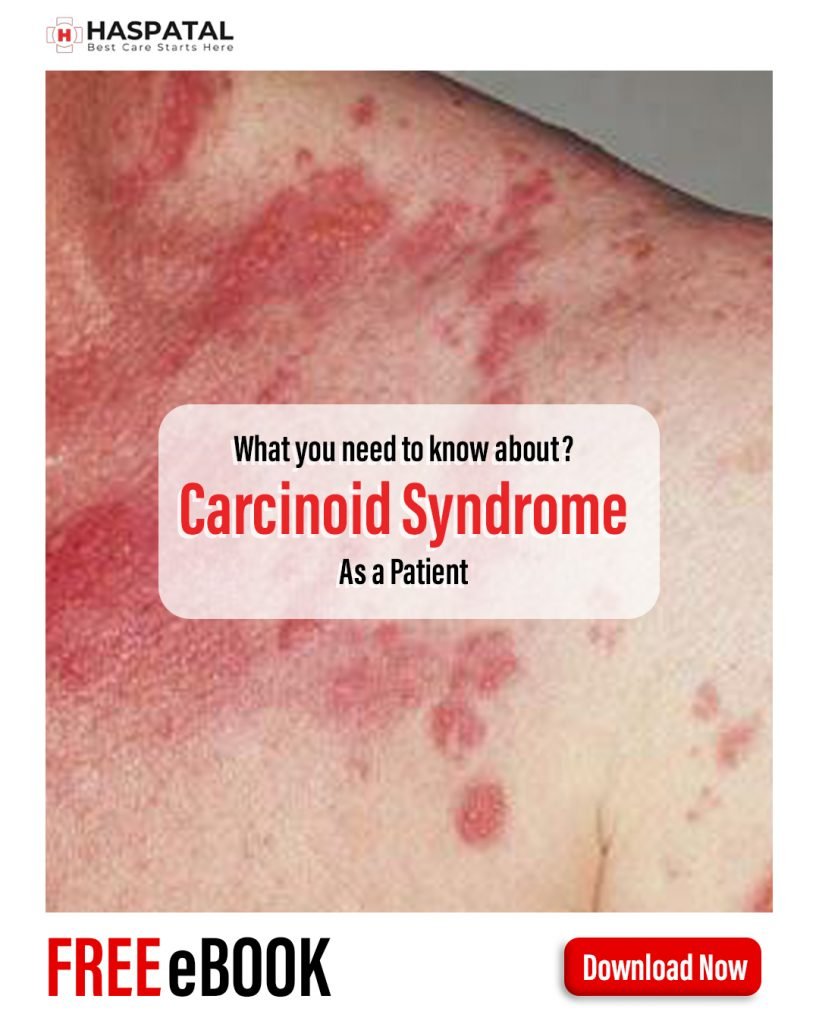 How carcinoid syndrome can affect your health? Haspatal online healthcare app.