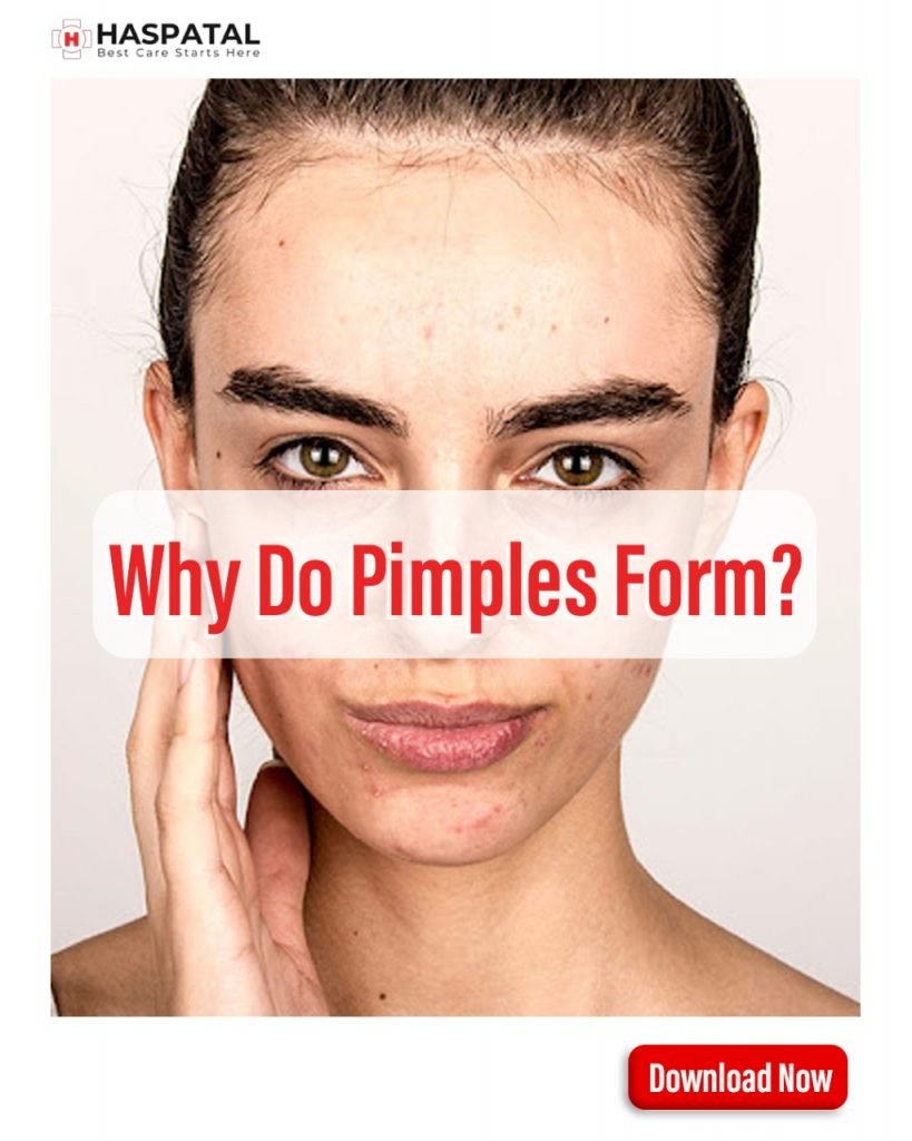 Why do pimples form? Haspatal online doctor consultation app.