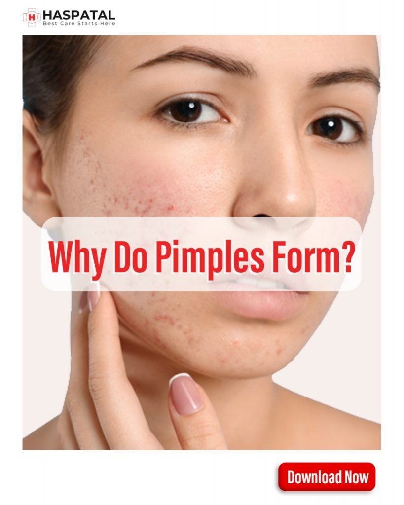 Why do pimples form? Haspatal online doctor consultation app.