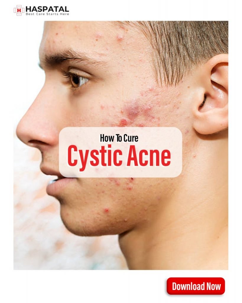 How do you get rid of cystic acne on your chin? Haspatal online doctor consultation app.