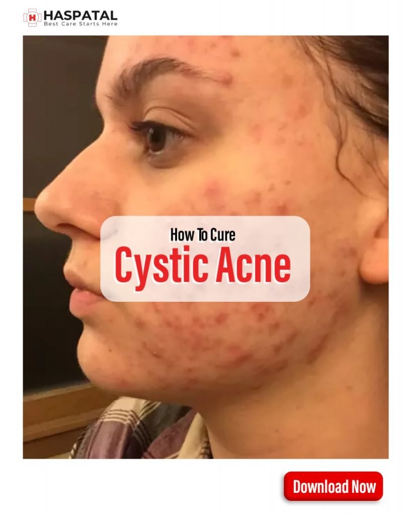 How do you get rid of cystic acne on your chin? Haspatal online doctor consultation app.
